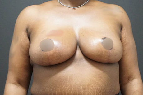 Breast Reduction case #3918