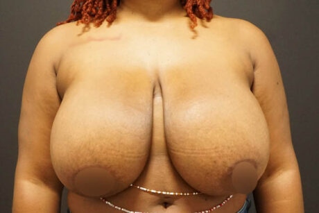 Breast Reduction case #3960