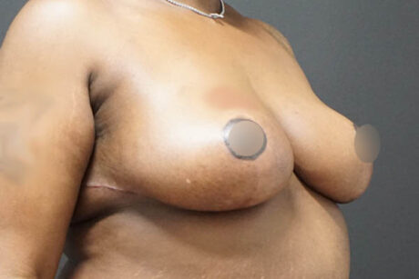 Breast Reduction case #3918
