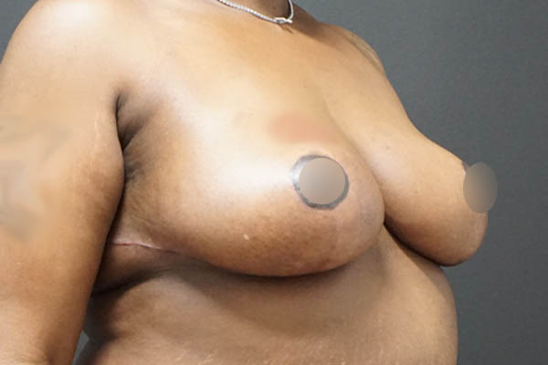 Breast Reduction case #3918