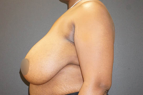 Breast Reduction case #3918
