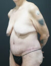 Tummy Tuck case #3970
