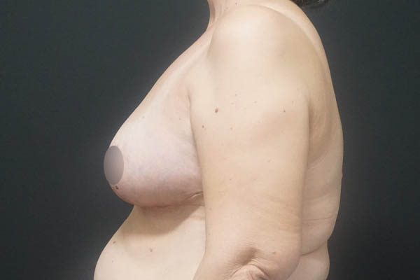 Breast Reduction case #3962