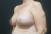 Breast Reduction case #3962