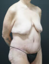 Tummy Tuck case #3970