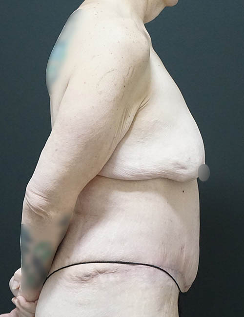 Tummy Tuck case #3970