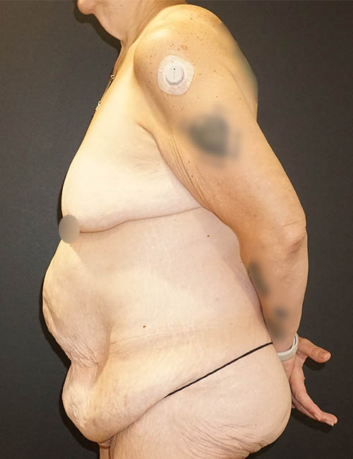 Tummy Tuck case #3970