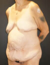 Tummy Tuck case #3970