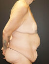 Tummy Tuck case #3970