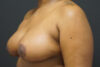 Breast Reduction case #3960