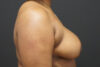 Breast Reduction case #3960