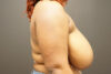 Breast Reduction case #3960