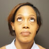 Eyelid Surgery case #3963