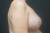 Breast Reduction case #3962
