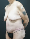 Tummy Tuck case #3970