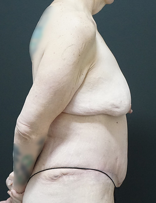 Tummy Tuck case #3970