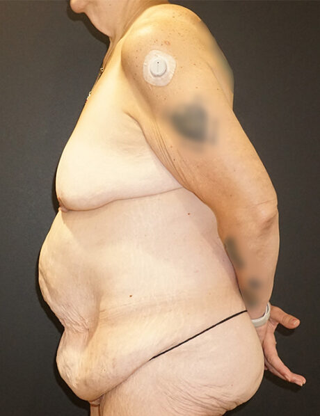 Tummy Tuck case #3970