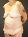 Tummy Tuck case #3970