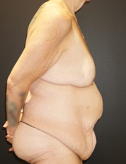 Tummy Tuck case #3970