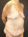 Tummy Tuck case #3970