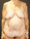 Tummy Tuck case #3970