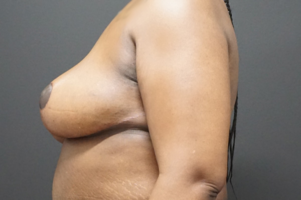 Breast Reduction case #3918