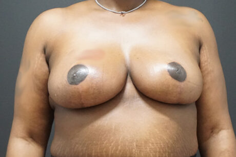Breast Reduction case #3918