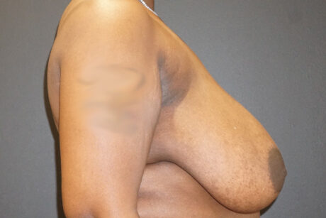 Breast Reduction case #3918
