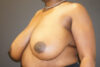 Breast Reduction case #3918