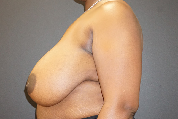 Breast Reduction case #3918