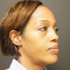 Eyelid Surgery case #3963