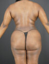 Liposuction case #4162
