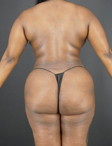 Liposuction case #4162
