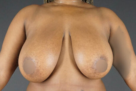 Breast Reduction case #4155