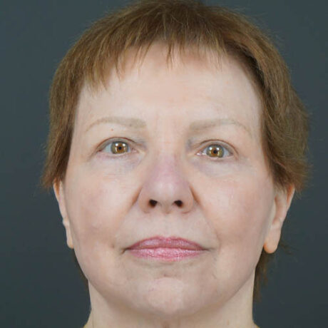 Eyelid Surgery case #4146