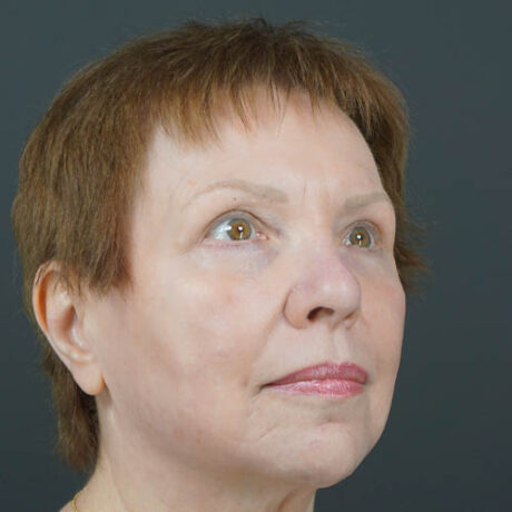Eyelid Surgery case #4146
