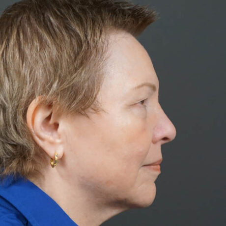 Eyelid Surgery case #4146