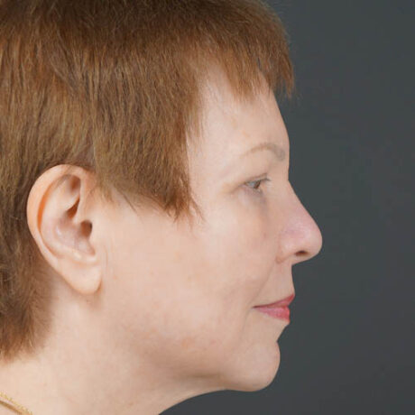 Eyelid Surgery case #4146