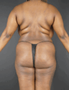 Liposuction case #4162