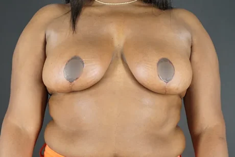 Breast Reduction case #4229