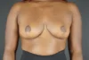 Breast Reduction case #4236