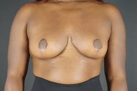 Breast Reduction case #4236