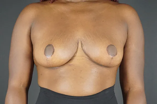 Breast Reduction case #4236