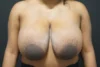 Breast Reduction case #4243