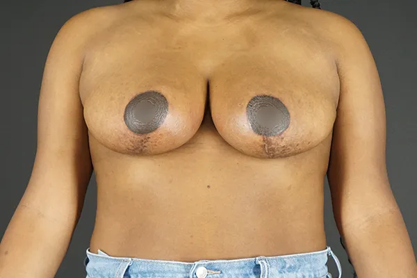 Breast Reduction case #4243