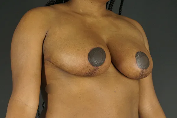 Breast Reduction case #4243