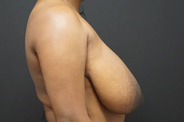 Breast Reduction case #4243
