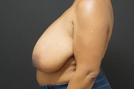 Breast Reduction case #4250
