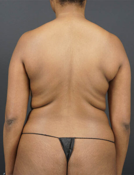 Liposuction case #4349