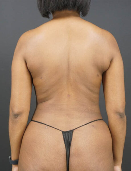 Liposuction case #4349